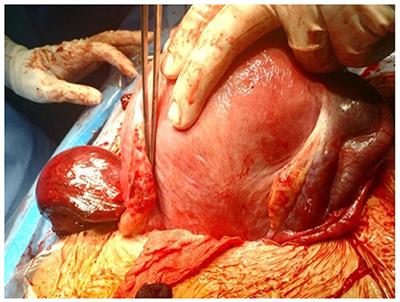 Isolated Tubal Torsion in a Term Pregnancy: Case Report and Systematic Review of Literature of the Last 10 Years